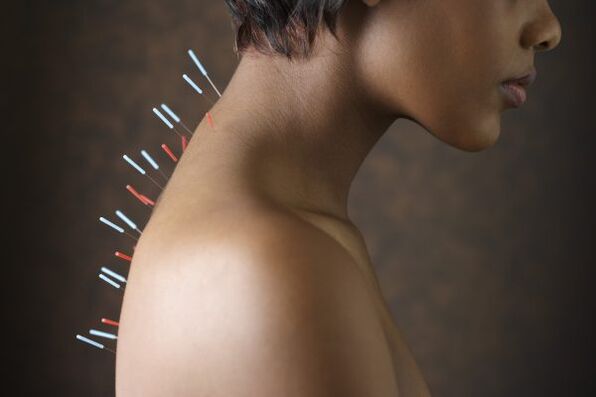 Agopuntura per il mal di schiena