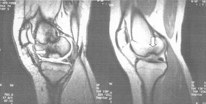 Radiografia dell'osteocondrite dissecante nell'articolazione del ginocchio