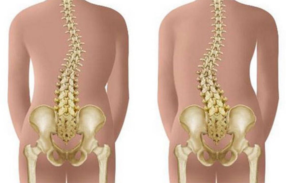 Scoliosi come causa di mal di schiena nella zona della scapola