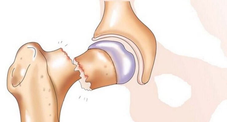 Una frattura del collo del femore è associata a un forte dolore all'articolazione dell'anca