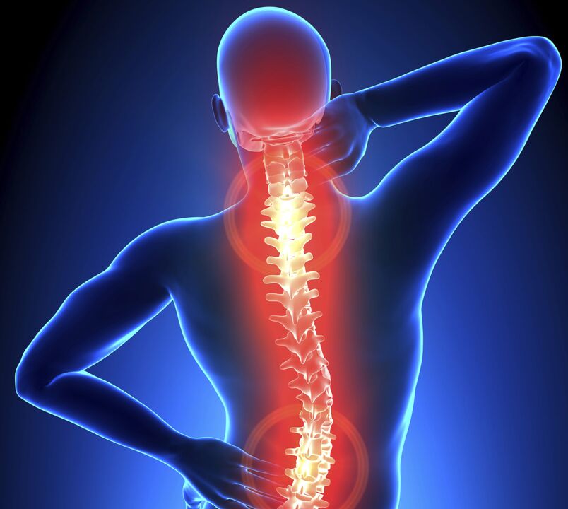 Osteocondrosi della colonna vertebrale