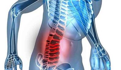 Segni e sintomi dell'osteocondosi lombare